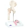 Fabrication Enterprises Inc. Anatomical Model: Femoral Fracture And Hip Osteoarthritis