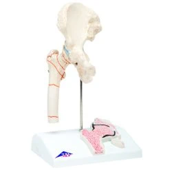 Fabrication Enterprises Inc. Anatomical Model: Femoral Fracture And Hip Osteoarthritis